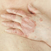 Ixekizumab bei Psoriasis-Arthritis